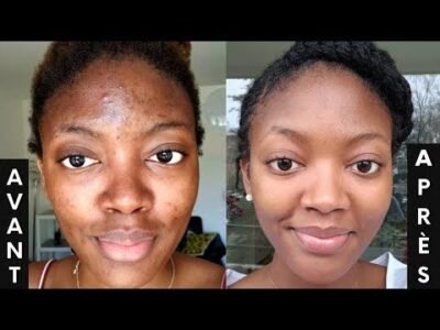 Tout savoir sur les taches sur le visage | Bane skincare Shop | Soins naturels - cosmetiques coreenes chez baneskincareshop.com